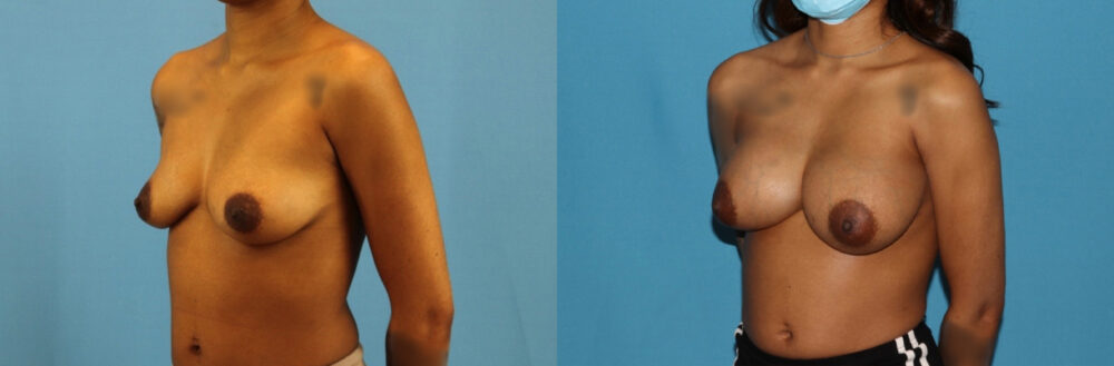 Breast Augmentation case #6346