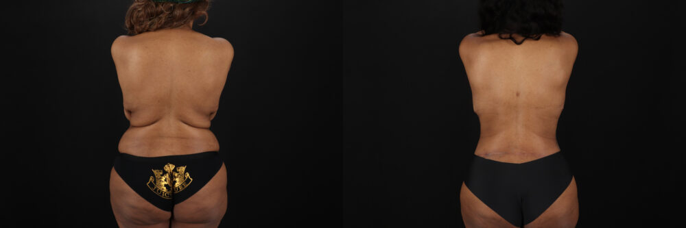 Post Bariatric Surgery (Massive Weight Loss) case #6782