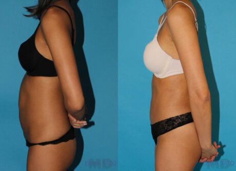 Tummy Tuck case #7231