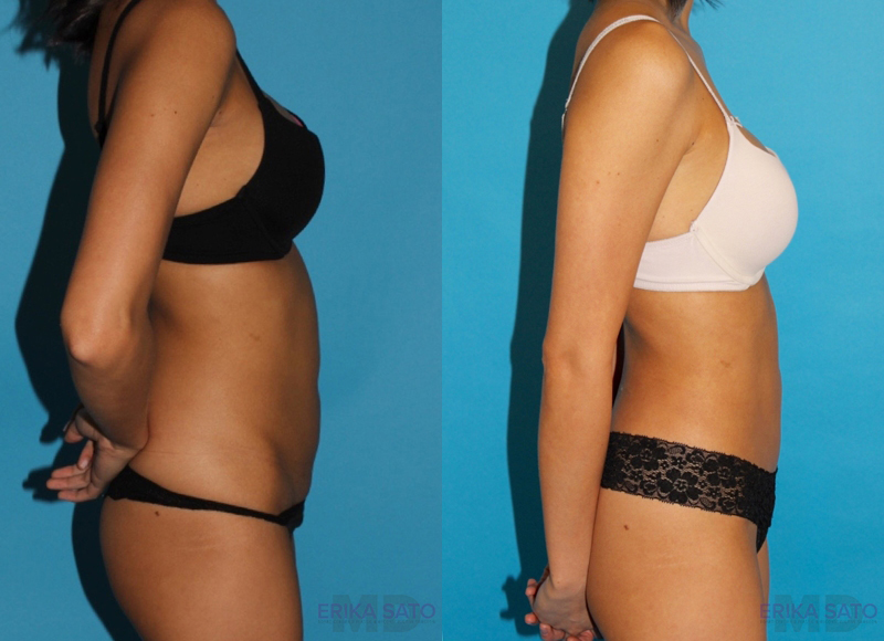 Tummy Tuck case #7231