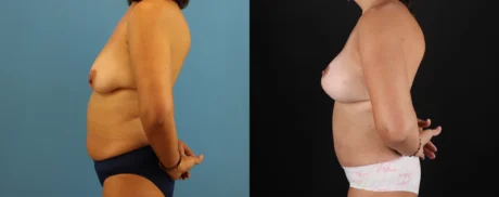 Mommy Makeover case #6520