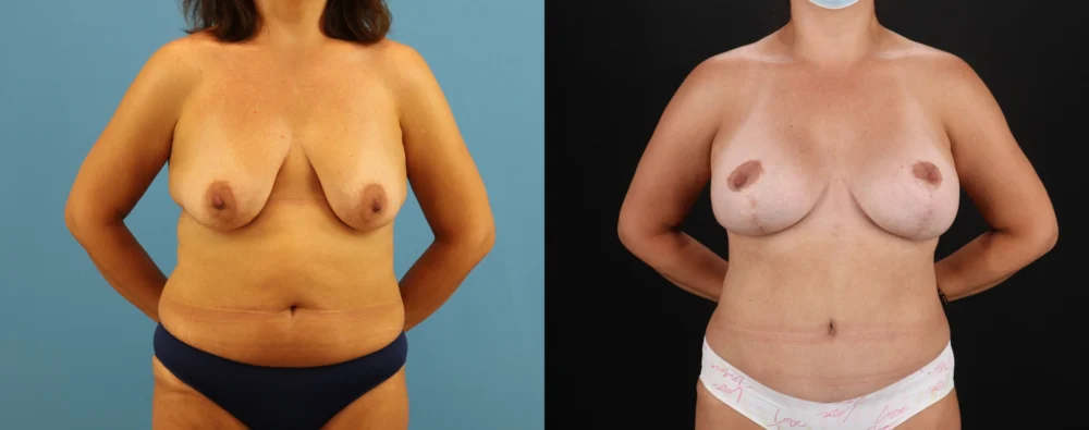 Mommy Makeover case #6520