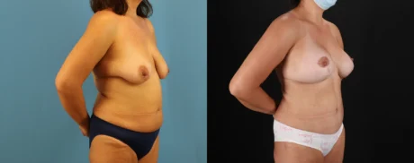 Mommy Makeover case #6520