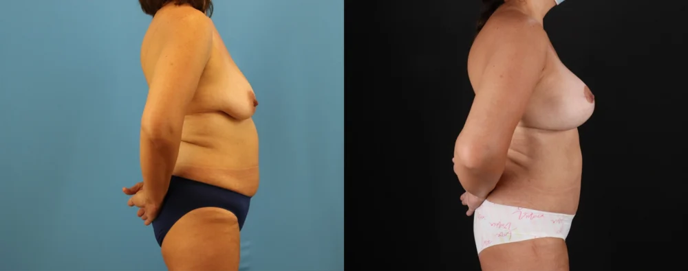 Mommy Makeover case #6520