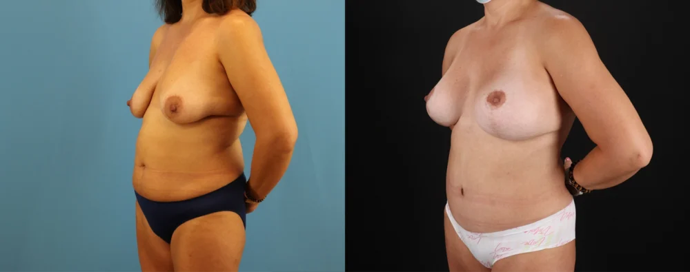 Mommy Makeover case #6520