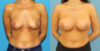 Breast Augmentation case #6352 slider thumbnail