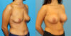 Breast Augmentation case #6352 slider thumbnail