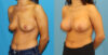 Breast Augmentation case #6352 slider thumbnail