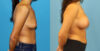 Breast Augmentation case #6352 slider thumbnail