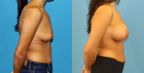 Breast Augmentation case #6352