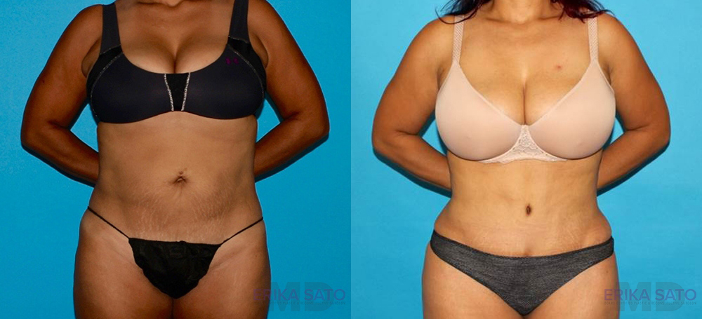 Tummy Tuck case #7230