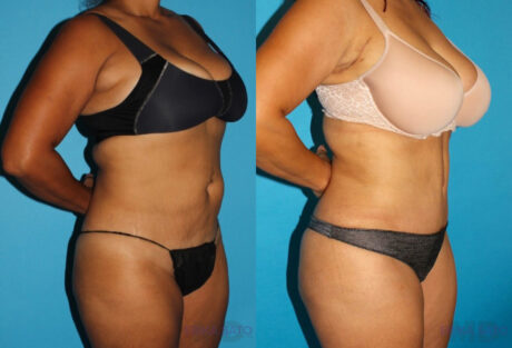 Tummy Tuck case #7230