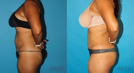 Tummy Tuck case #7230