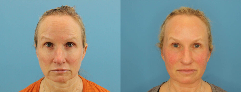 Profound RF Skin Tightening case #6906