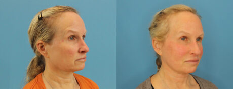 Profound RF Skin Tightening case #6906