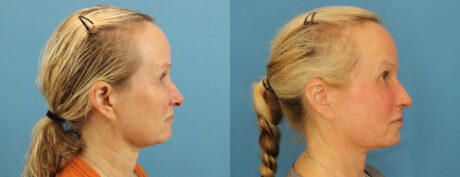 Profound RF Skin Tightening case #6906