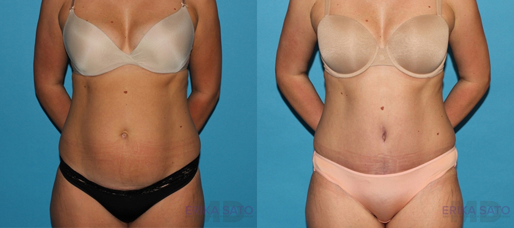 Tummy Tuck case #7229