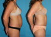 Tummy Tuck case #7229 slider thumbnail
