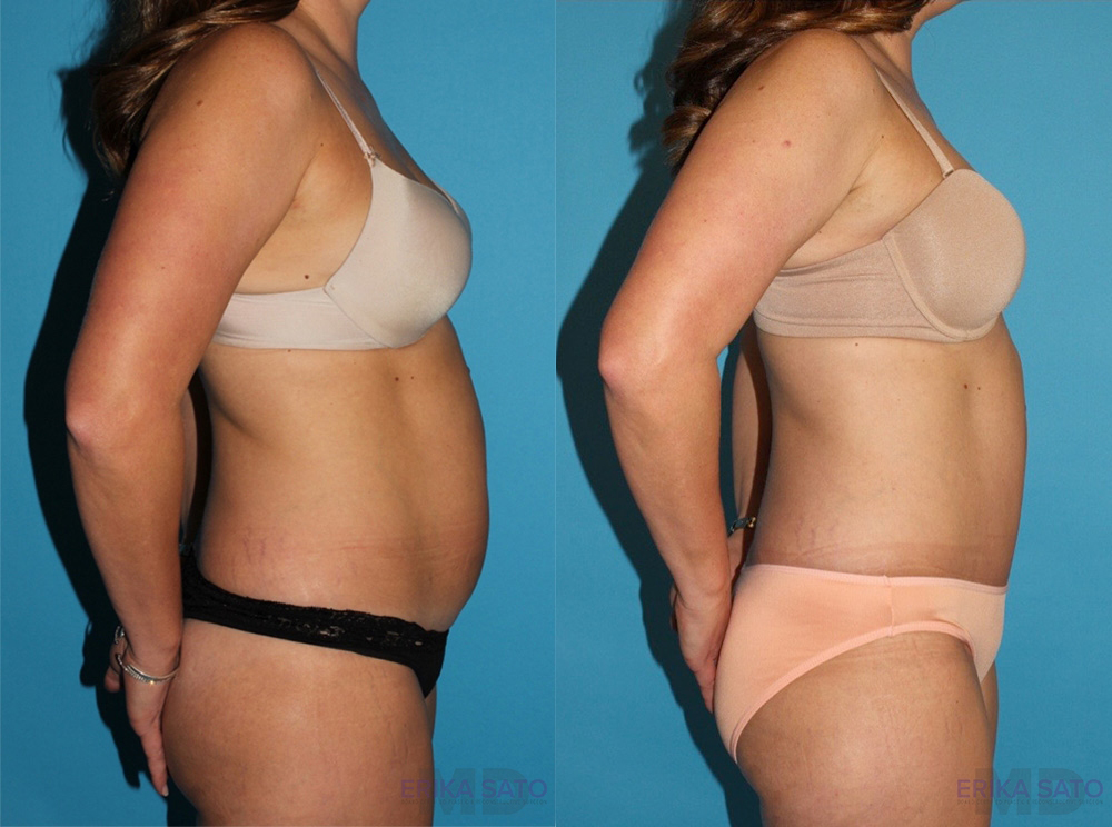 Tummy Tuck case #7229
