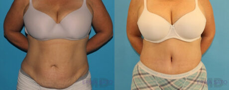 Tummy Tuck case #7172