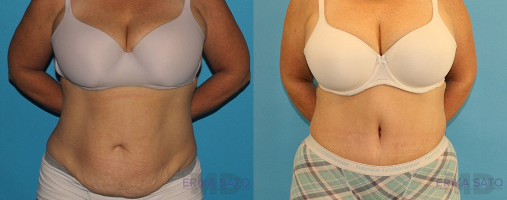 Tummy Tuck case #7172