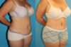 Tummy Tuck case #7172 slider thumbnail