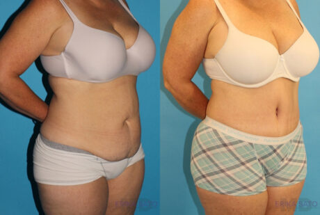 Tummy Tuck case #7172
