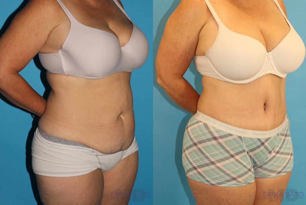 Tummy Tuck case #7172