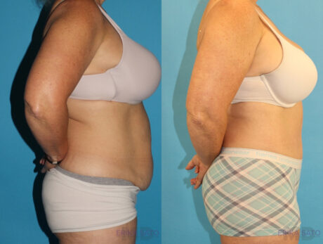 Tummy Tuck case #7172