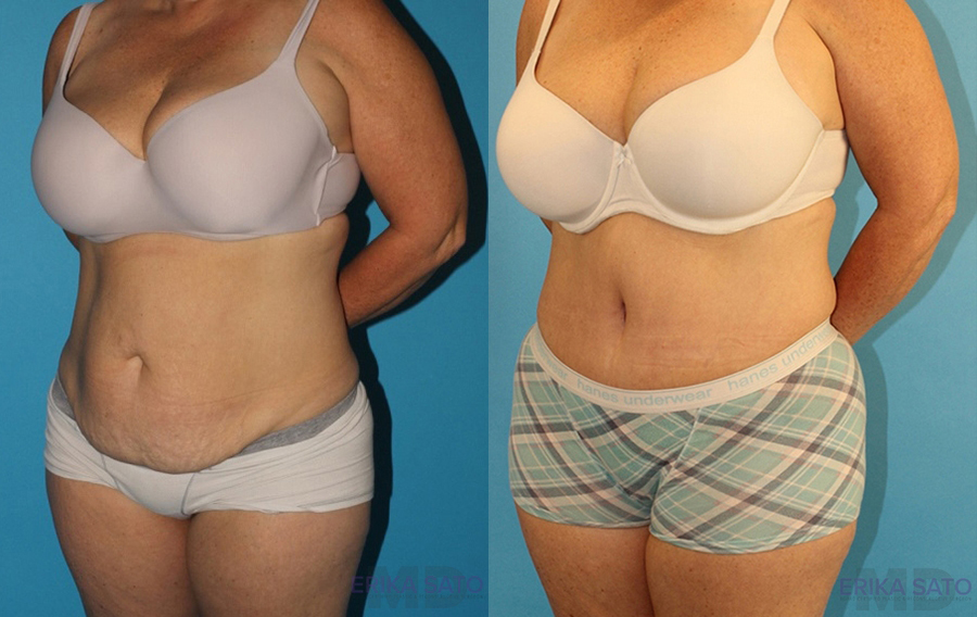 Tummy Tuck case #7172
