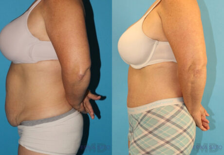 Tummy Tuck case #7172