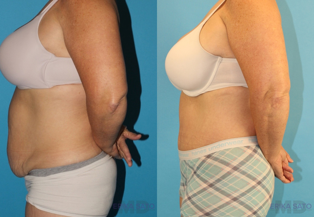 Tummy Tuck case #7172
