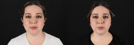 Submental Liposuction case #6957