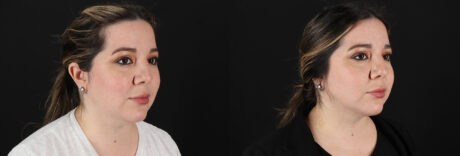 Submental Liposuction case #6957