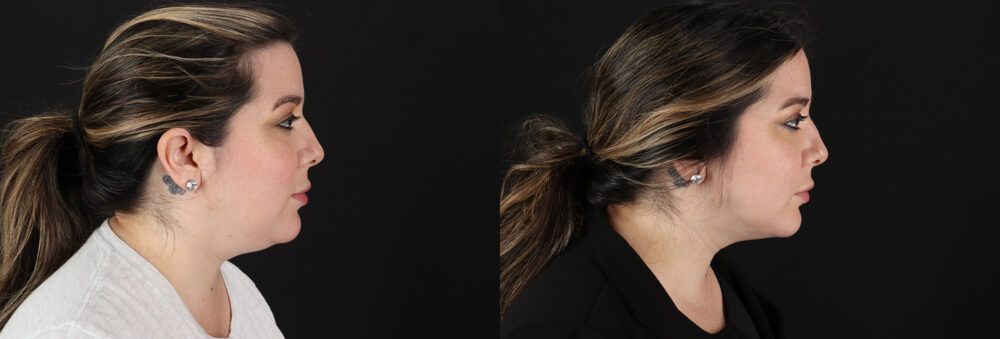 Submental Liposuction case #6957