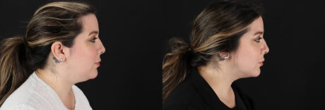 Submental Liposuction case #6957