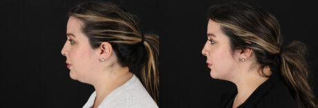 Submental Liposuction case #6957