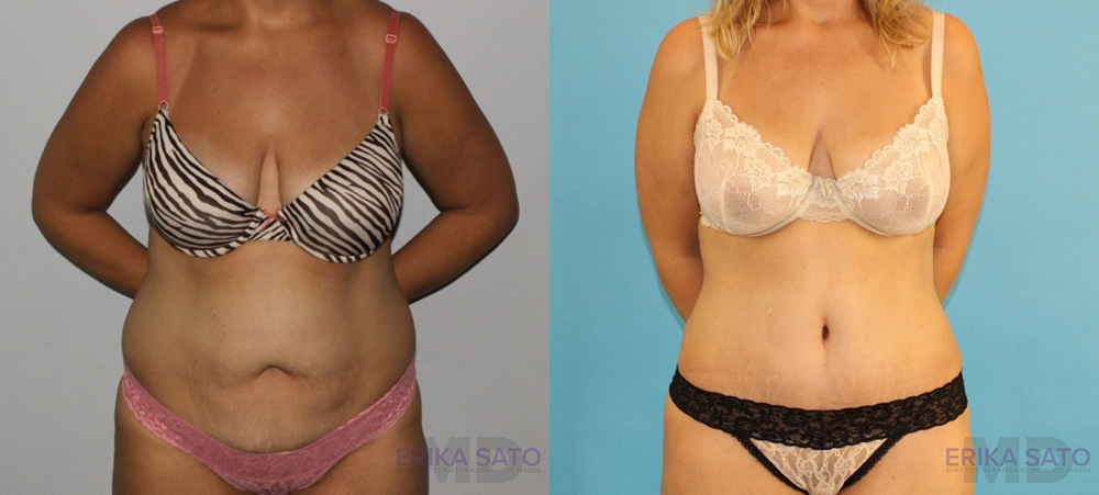 Tummy Tuck case #7228