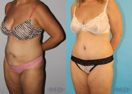 Tummy Tuck case #7228