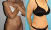 Tummy Tuck case #7164 slider thumbnail