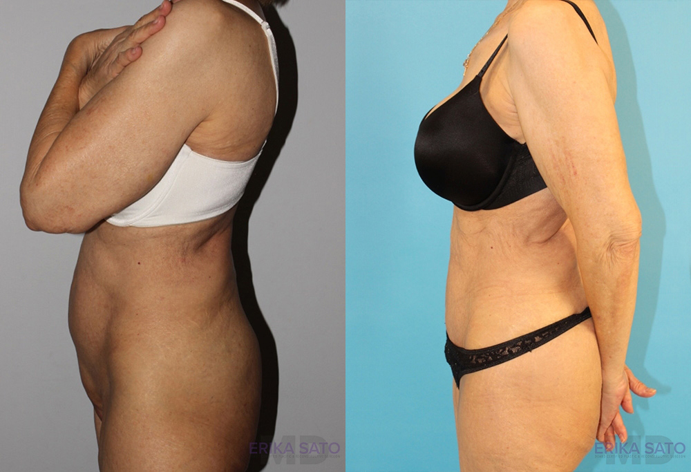 Tummy Tuck case #7164