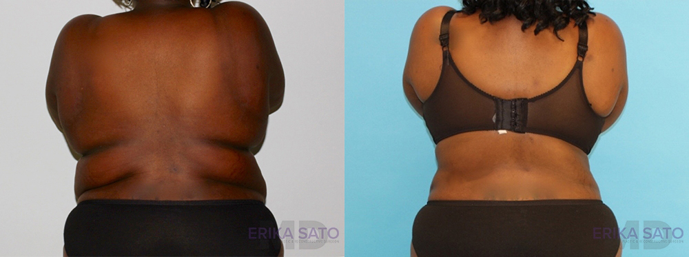 Tummy Tuck case #7084