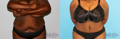Tummy Tuck case #7084
