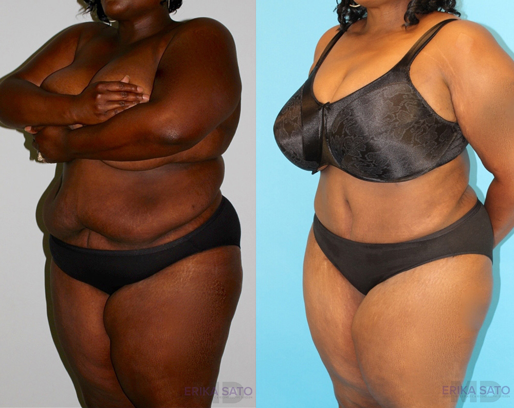 Tummy Tuck case #7084