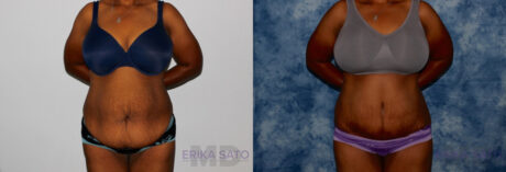 Tummy Tuck case #7082