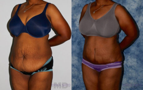 Tummy Tuck case #7082
