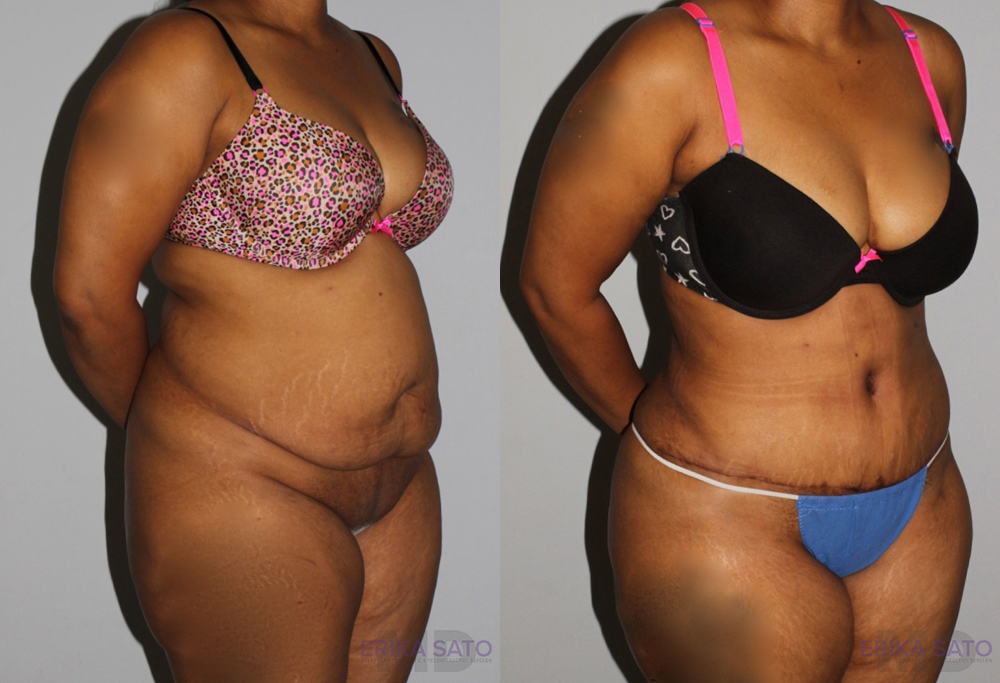 Tummy Tuck case #7083