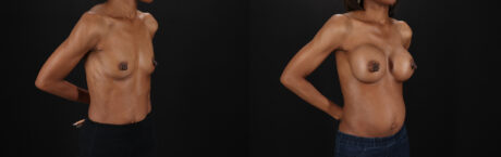 Breast Augmentation case #6485