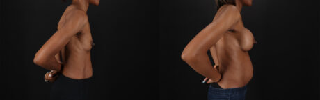 Breast Augmentation case #6485