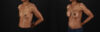 Breast Augmentation case #6485 slider thumbnail